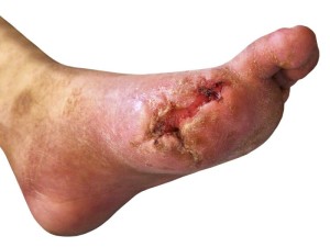 Diabetic-Foot-Ulcer